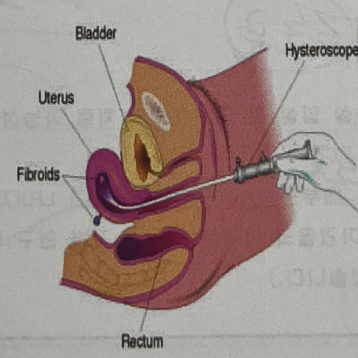 자궁근종수술 자궁경수술